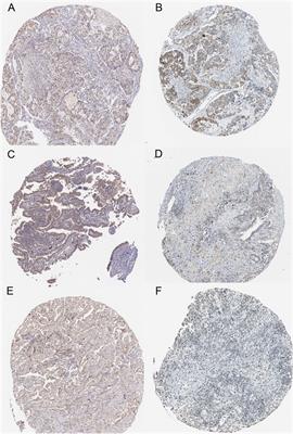 Chemokine CCL17 Affects Local Immune Infiltration Characteristics and Early Prognosis Value of Lung Adenocarcinoma